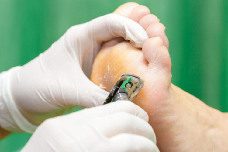 Heel Corn vs Plantar Wart: Key Differences & Treatments